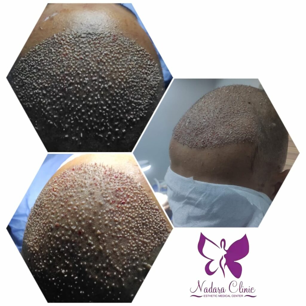 زراعة الشعر بتقنية السفير